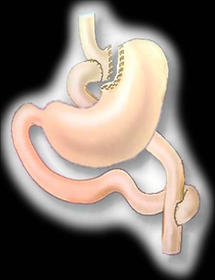 Does Gastric Bypass Work